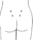 A diagram showing a person&rsquo;s lower back with four marks showing the locations SWIs are given.