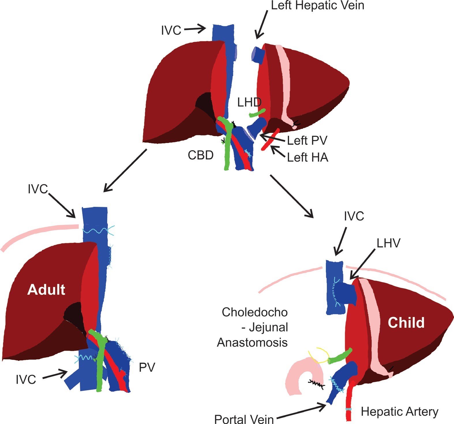 Diagram of &ldquo;Split&rdquo; Liver Transplantation